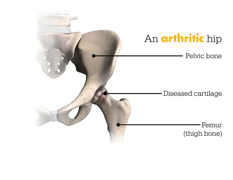 arthritic hip graphic