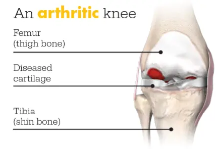 arthritic knee graphic