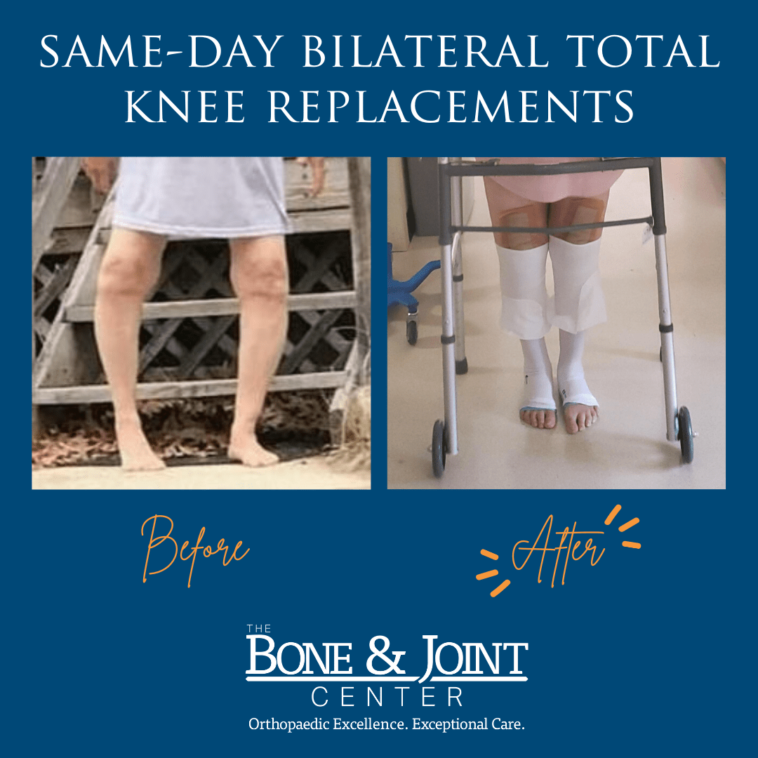 Bilateral Knee