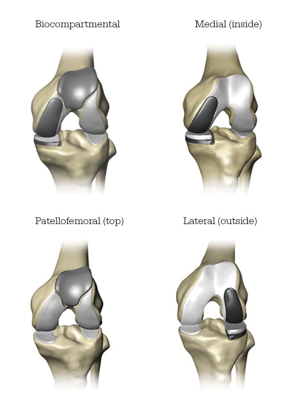 knee replacement graphic
