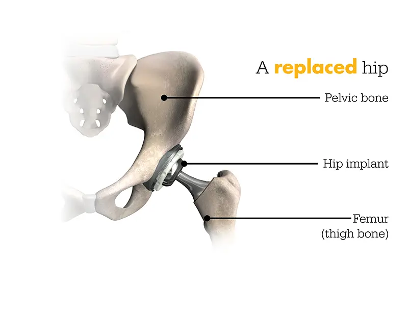 replaced hip graphic